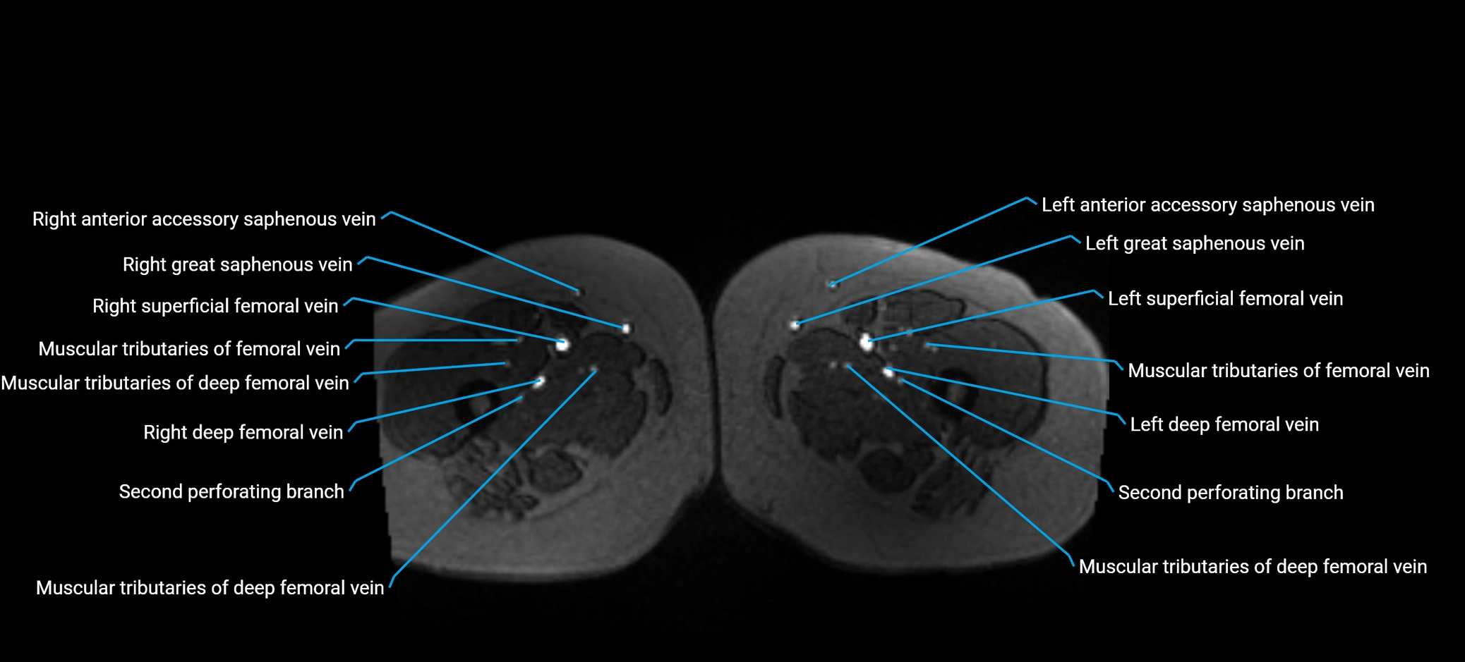 MRV abdomen pelvis & lower limb axial cross sectional anatomy labelled MRI image 232 (1).webp